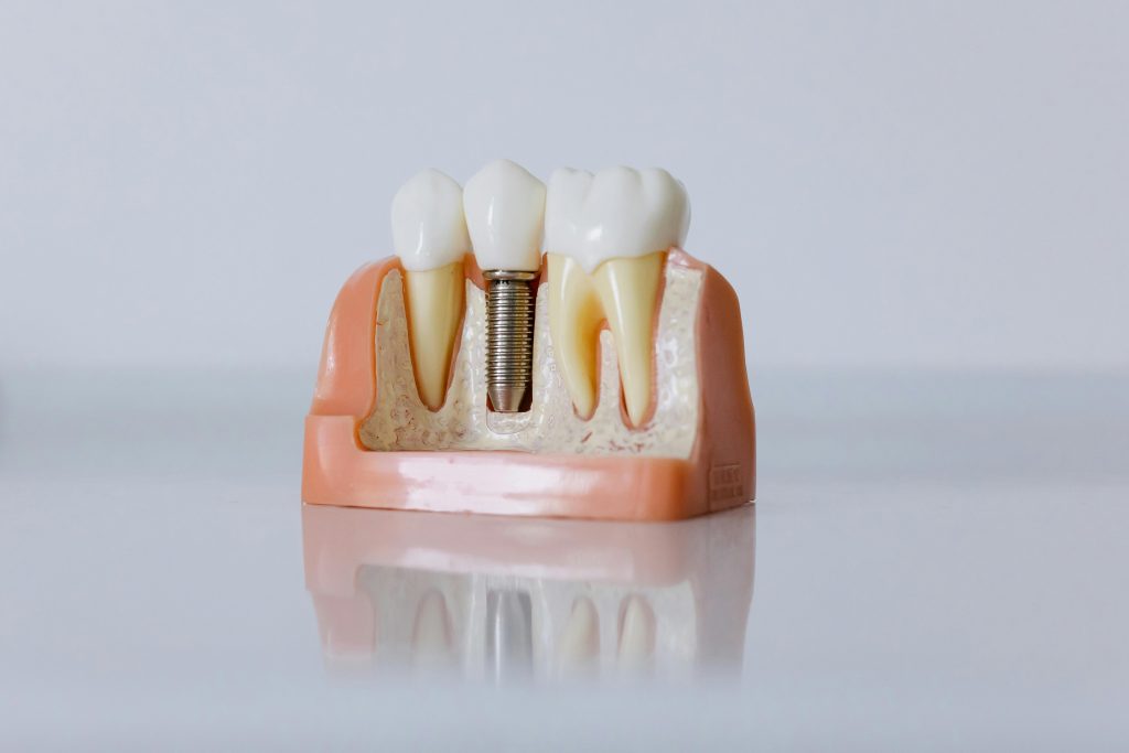 tooth implant